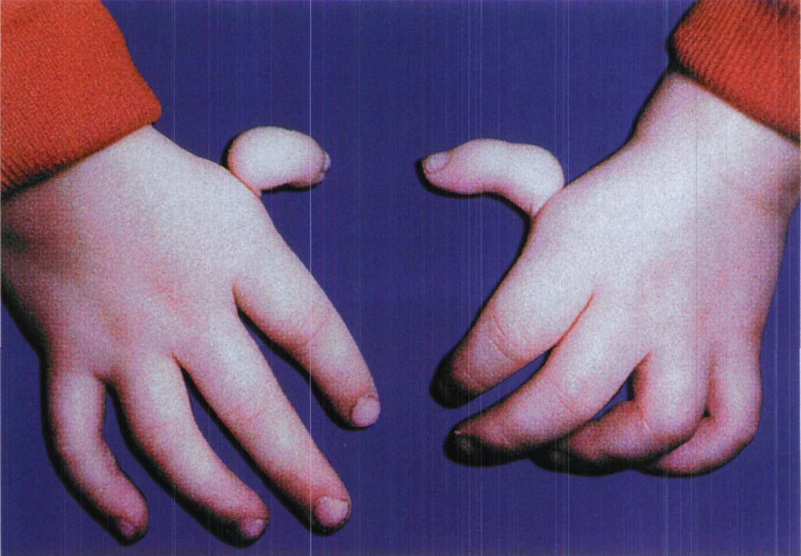 图1-26 第1掌骨缺如，漂浮拇指